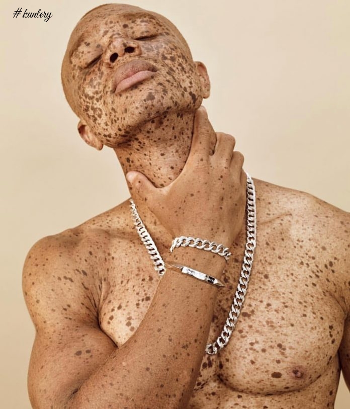 Freckles Took Him From Being Bullied To Being A Super Model; Meet Ralph Souffrant