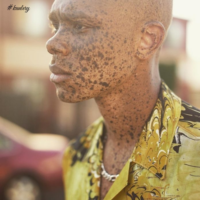 Freckles Took Him From Being Bullied To Being A Super Model; Meet Ralph Souffrant